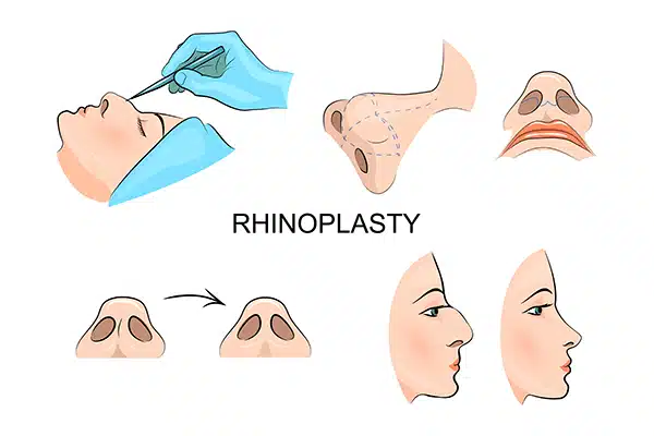 Rhinoplasty Surgery