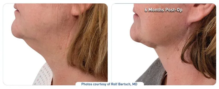 renuvion before after neck10 dr bartsch photos