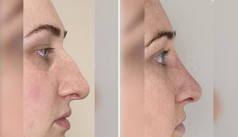 rhinoplasty before and after