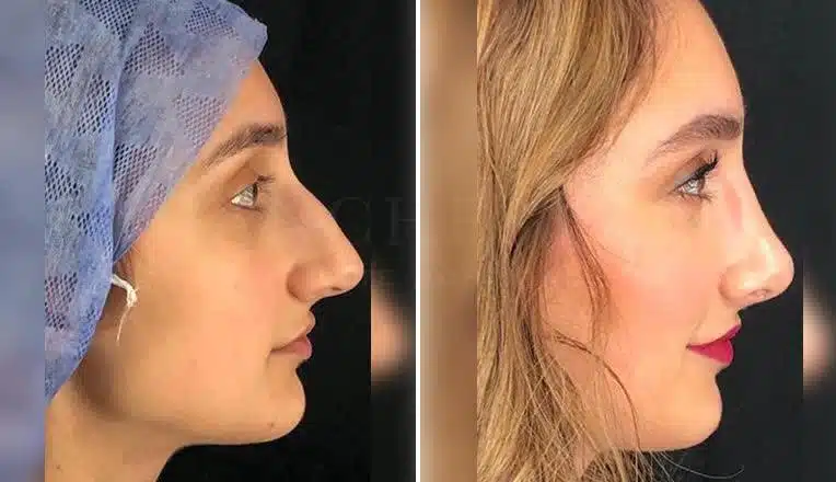 rhinoplasty before and after