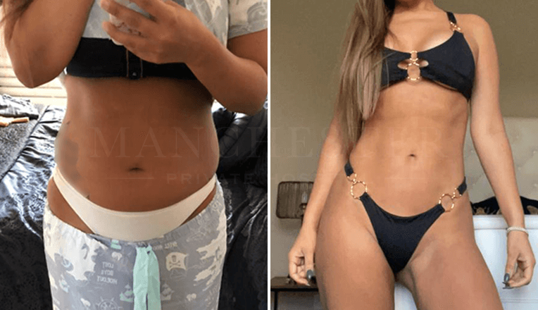 stomach vaser liposuction before and after