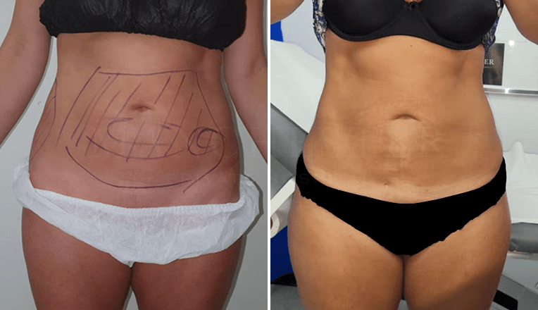 stomach vaser liposuction before and after