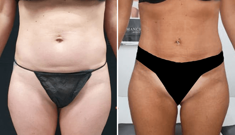 stomach vaser liposuction before and after