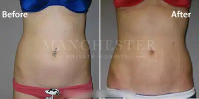 stomach vaser liposuction before and after