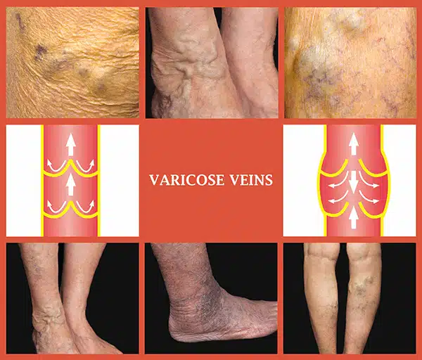 varicose veins treatment