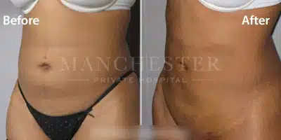 vaser lipo before after