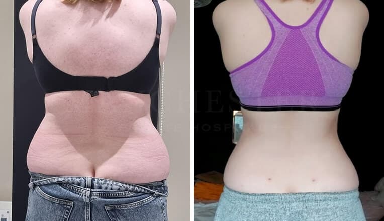 vaser lipo before after