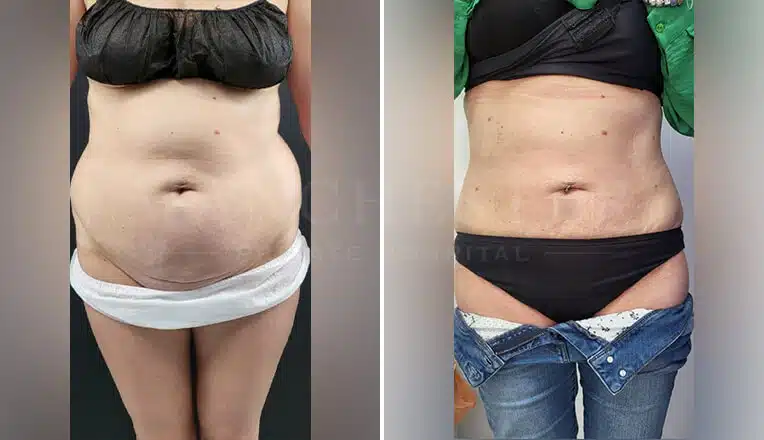 vaser lipo before and after stomach