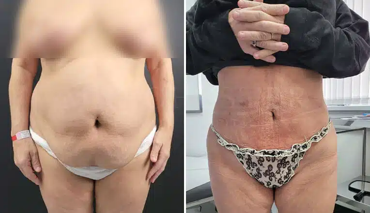 vaser lipo before and after stomach