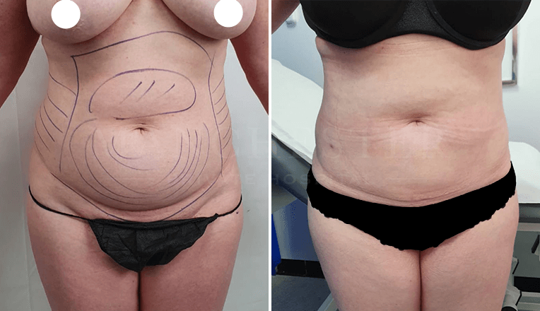 vaser lipo before and after stomach