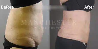 vaser lipo before and after stomach