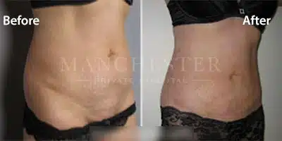 vaser lipo before and after stomach