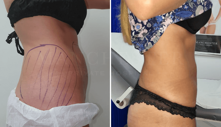 vaser liposuction before and after