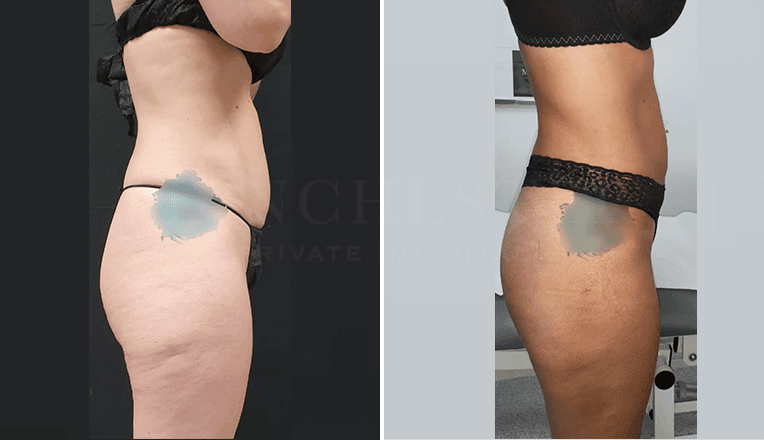 vaser liposuction before and after