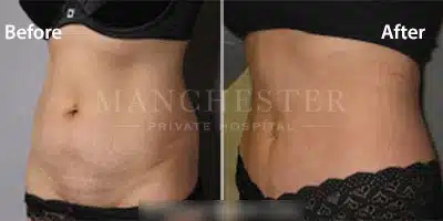 vaser liposuction before and after