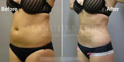 vaser liposuction before and after