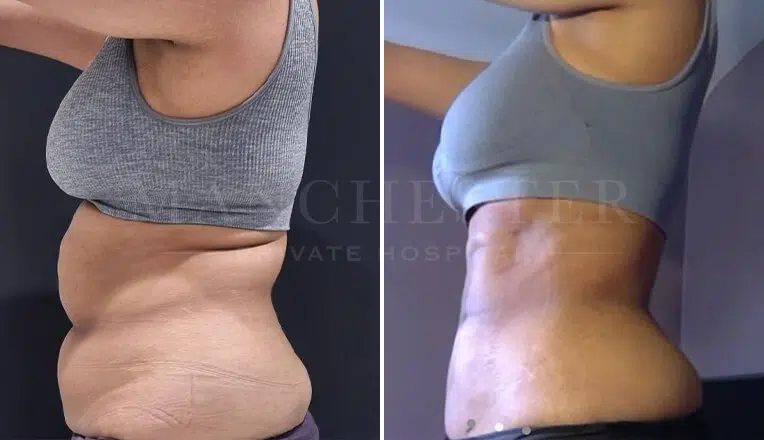 vaser liposuction before and after