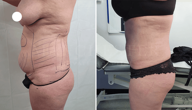 vaser liposuction before and after