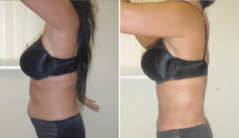 vaser liposuction before and after