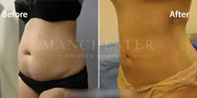 vaser liposuction female abs before and after