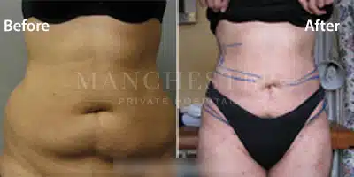 vaser liposuction female abs before and after