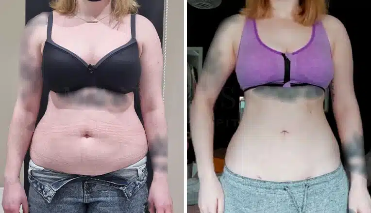 vaser liposuction female abs before and after