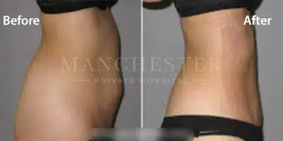 vaser liposuction female abs before and after