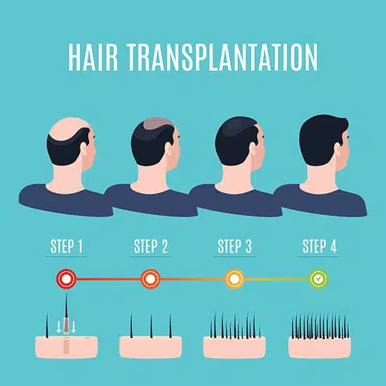 hair-transplant