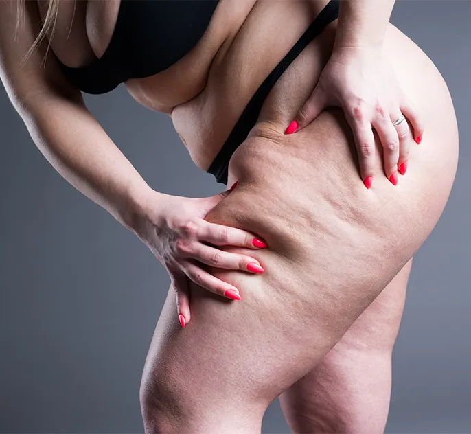 lipoedema liposuction