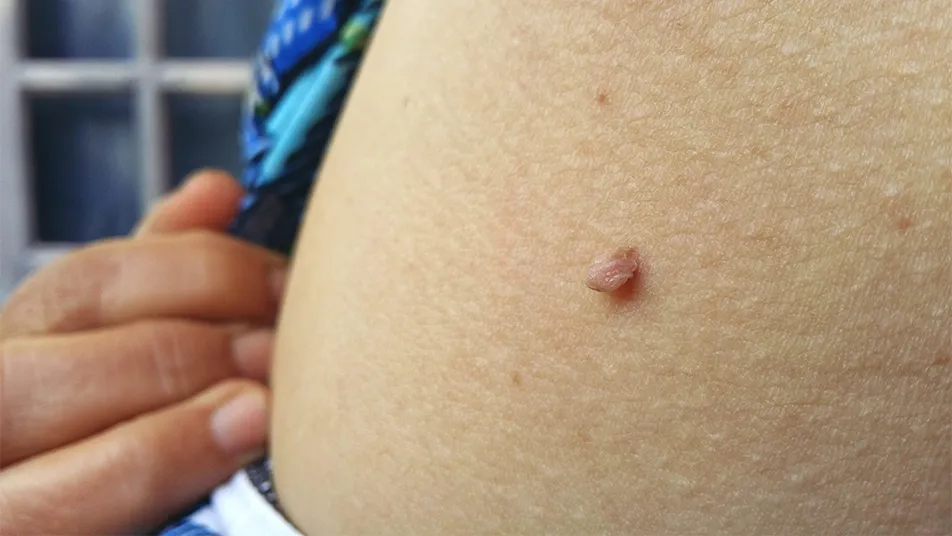 Skin Tag Removal In Manchester