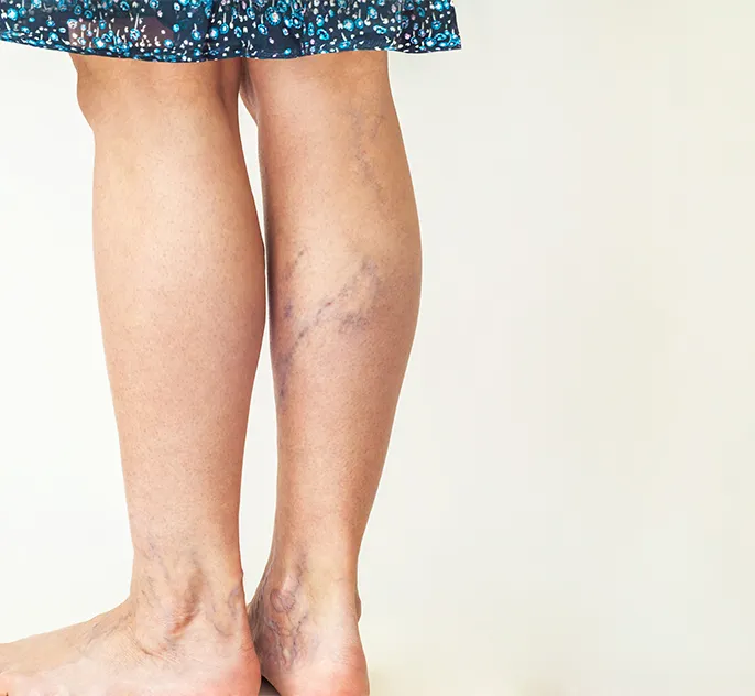 varicose vein removal manchester