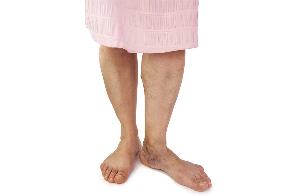 Varicose Veins