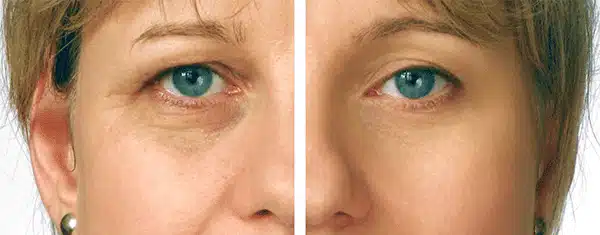 Eyelid Correction Surgery