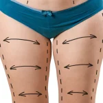 Thigh Lift – The Best Cosmetic Surgical Procedure For Youthful Appearance