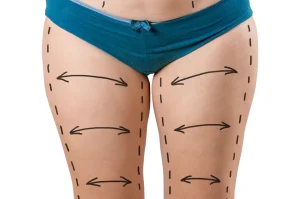 Thigh Lift – The Best Cosmetic Surgical Procedure For Youthful Appearance