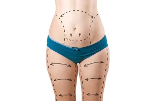 Vaser Liposuction – The Best Way to Remove Excess Fat in Minimally Invasive Procedure