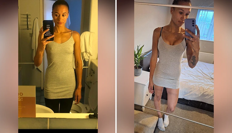 breast augmentation before and after results-1