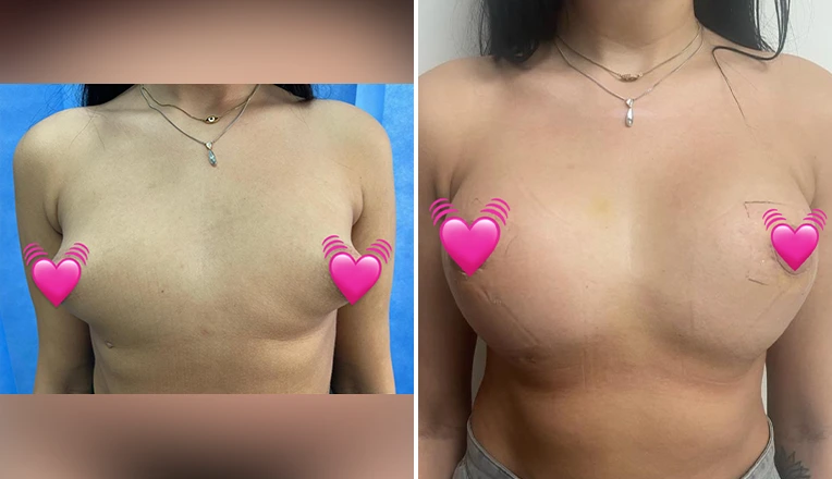 breast enlargement patient results-1