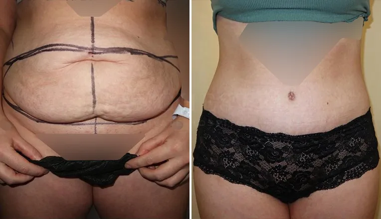 abdominoplasty before and after