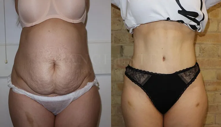 abdominoplasty before and after