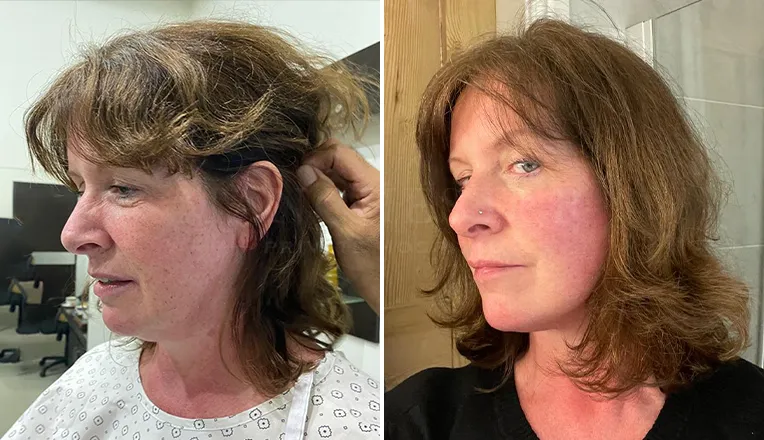 facelift before and after result