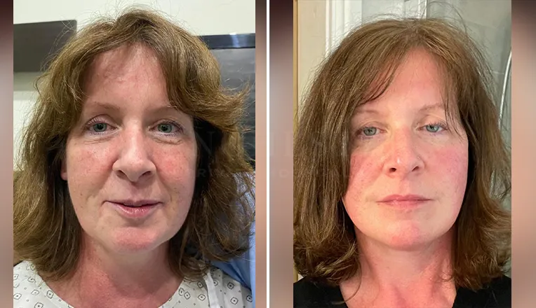 facelift patient before and after result