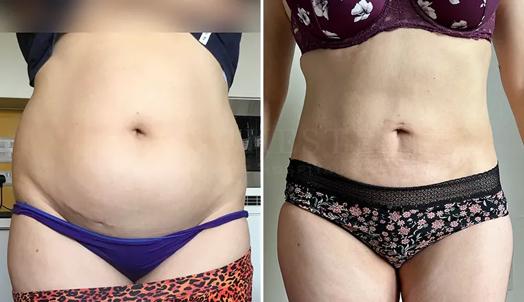 stomach vaser liposuction before and after