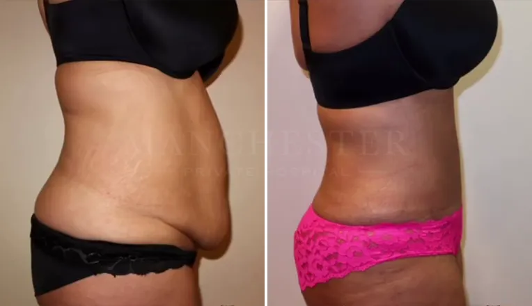 tummy tuck before and after