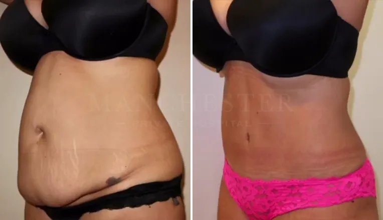 tummy tuck before and after