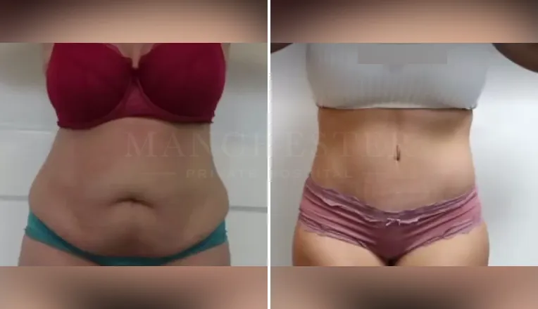 tummy tuck before and after-3