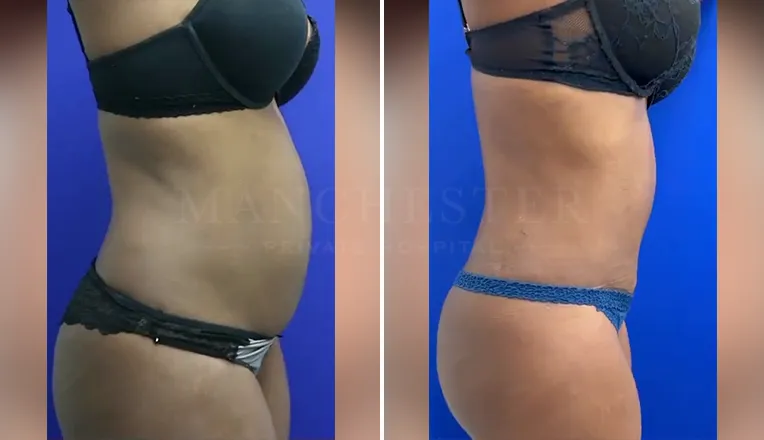 tummy tuck before and after result