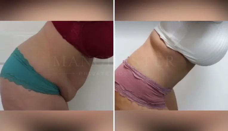 tummy tuck before and after result-2