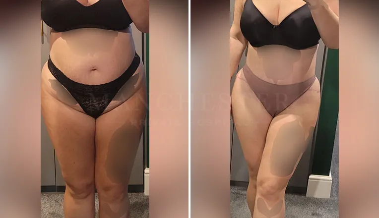 tummy tuck before and after uk