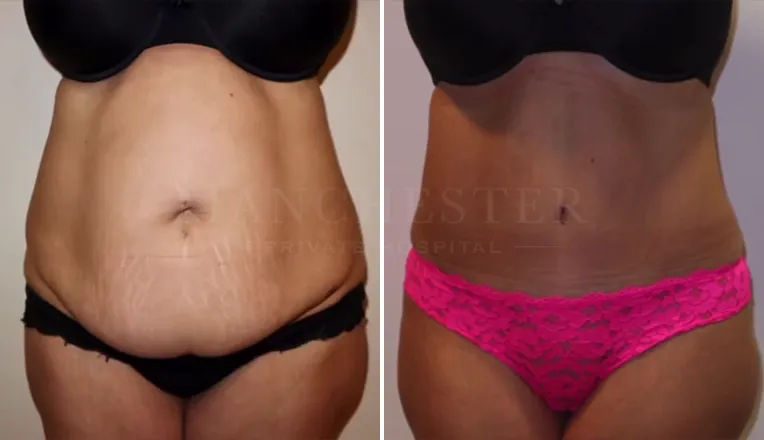 tummy tuck before and after